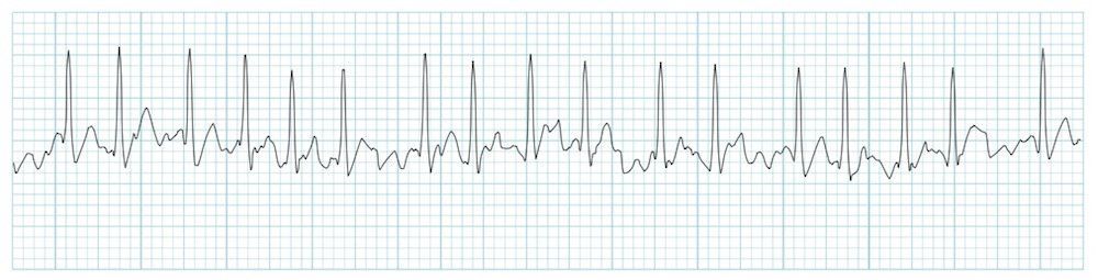 Heart arrhythmia rhythm strip readings