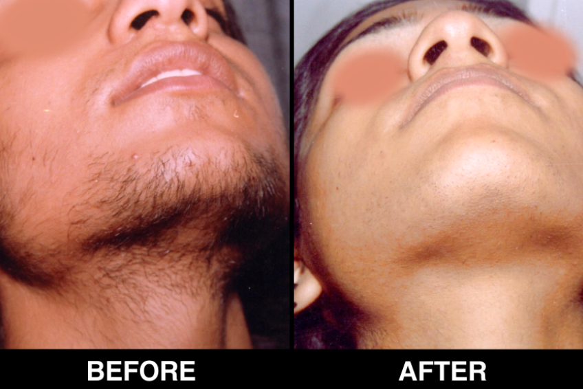 Treatment for female facial hair