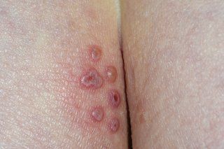 Paws reccomend Painful blister on vulva