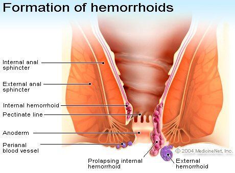 best of Hemorrhoids Anal bleeding