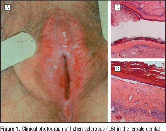 Pictures of vulva lichen sclerous