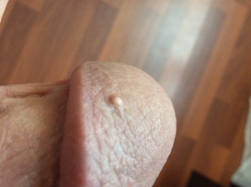 Kevlar reccomend Bump on penis hole