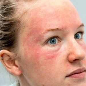 Facial seborretic dermatitus