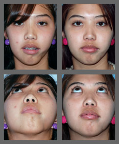 Pigtail reccomend Facial fat grafts injections