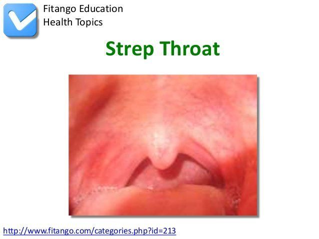 Adult strept throat
