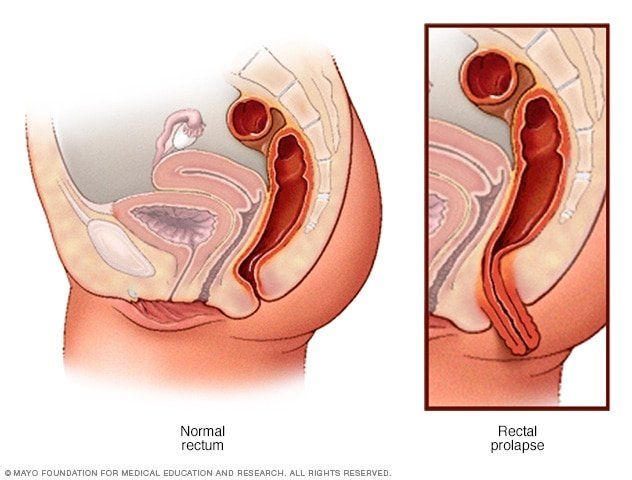 The E. reccomend Surgery of the anus rectum and colon