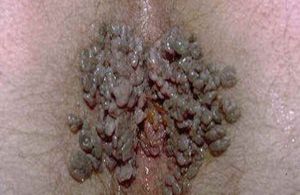 Hpv virus anal warts pictures