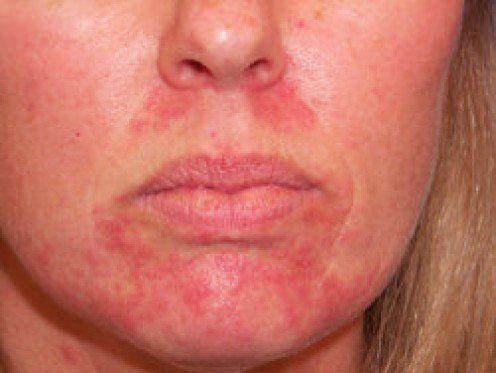 Golden G. reccomend Treatment for facial rash