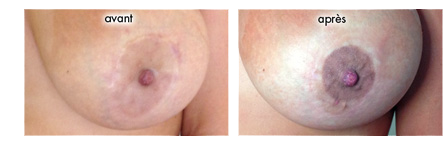 Finch reccomend Areola boob implants
