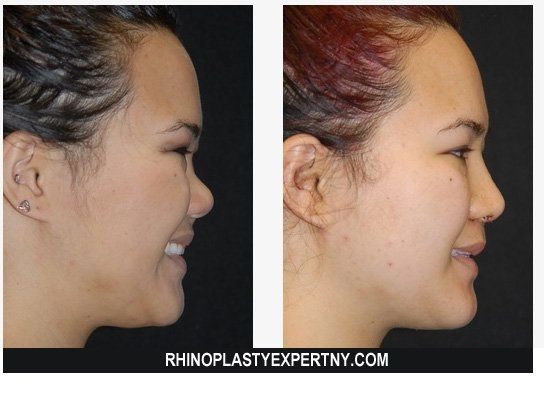 Candy C. reccomend Asian nose augmentation