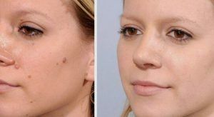 best of Mole removals Facial