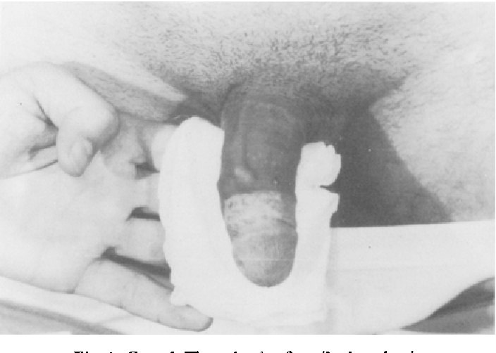 Deep Thrombosis Of Penis Random Photo Gallery