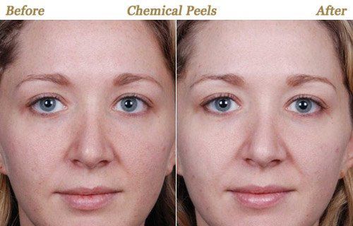 Tart reccomend Facial treatments laser chemical peel
