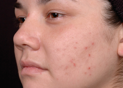 Mild adult acne