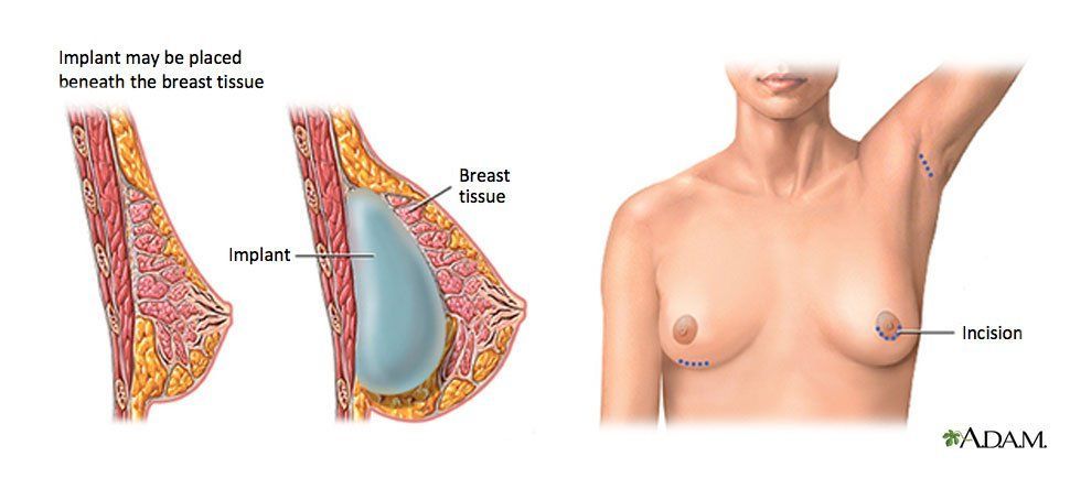 Alias reccomend Areola boob implants