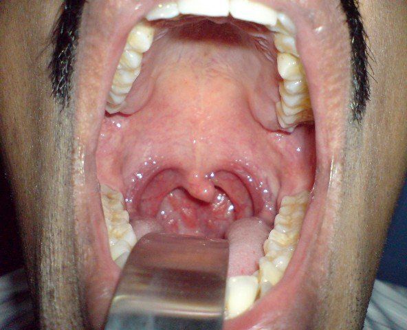 Adult in recurrent strep throat