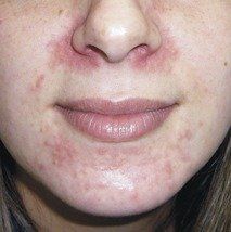 best of I skin rashes can of facial Where pictures find