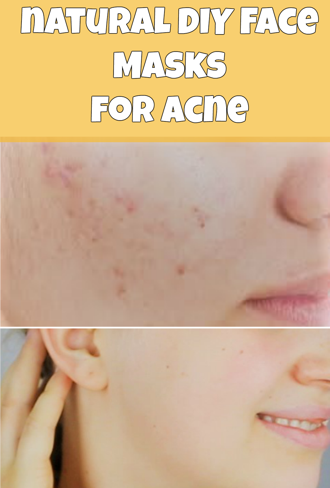 Homemade facial mask for acne prone skin