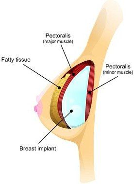 Areola boob implants