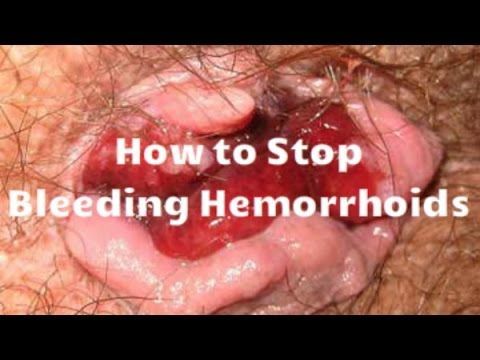 Preach reccomend Anal bleeding hemorrhoids