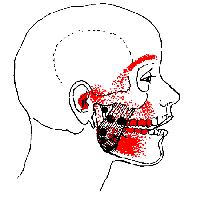 Facial pain zygo