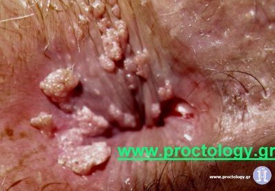 Sling reccomend Hpv virus anal warts pictures