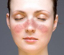 best of For rash Treatment facial