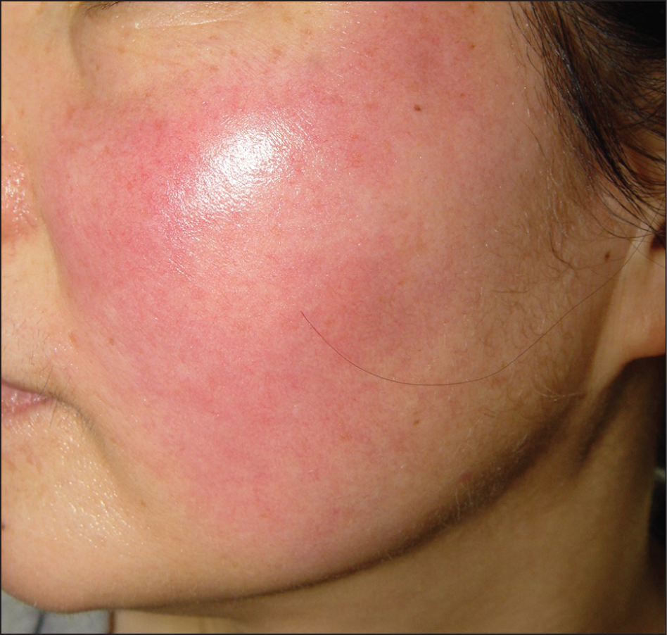 Goobers reccomend Facial erythema facial edema lupus