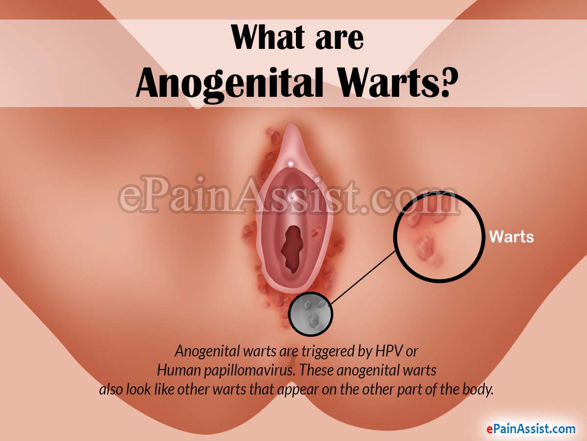 Hpv virus anal warts pictures