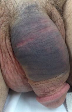 Deep thrombosis of penis