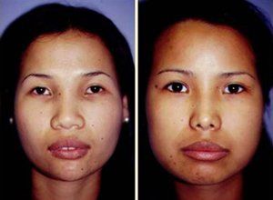 Asian nose augmentation