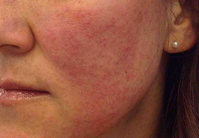 Treatment for facial rash