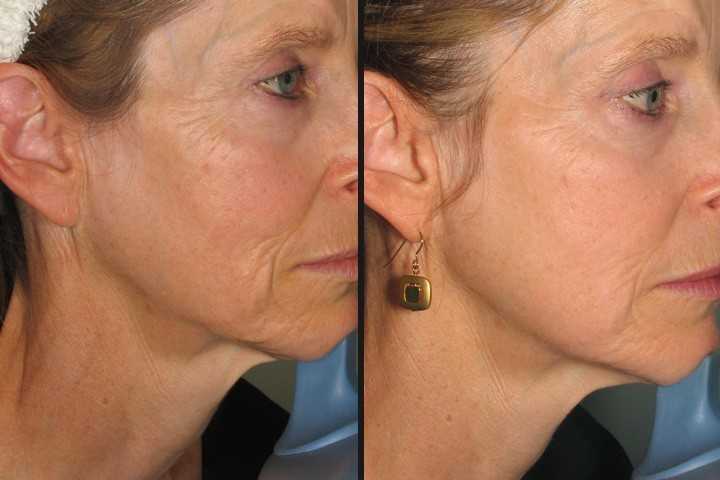 best of Dry skin Severely and laser facial