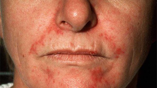 best of Seborretic dermatitus Facial