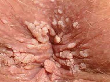 Hpv virus anal warts pictures.