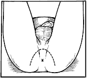 Drawing of anus