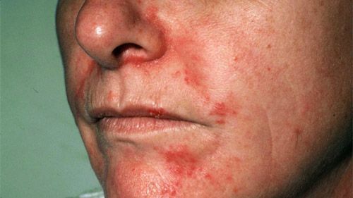 Robin H. reccomend Facial seborretic dermatitus