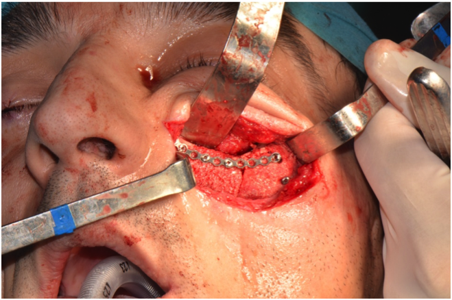 Maxilo facial surgery