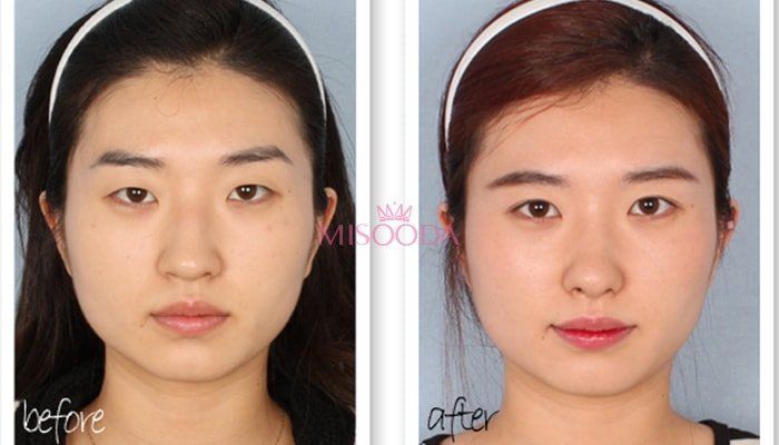 Sundance K. reccomend Asian nose augmentation