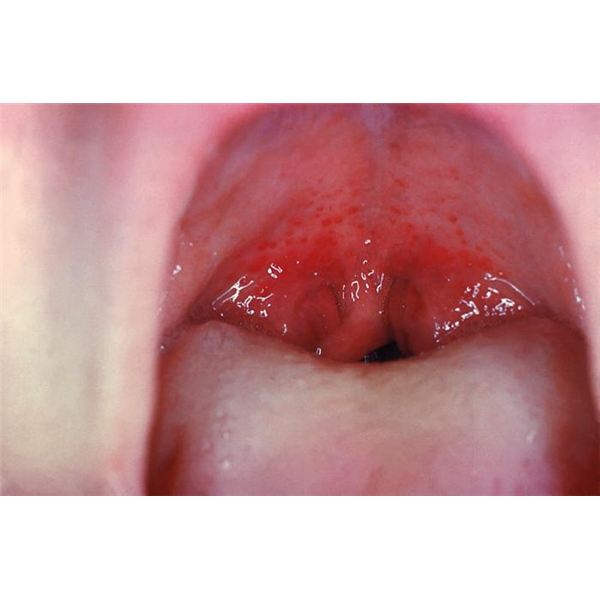 Duckling reccomend Adult in recurrent strep throat