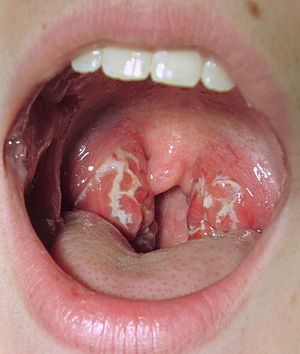 best of Recurrent strep throat Adult in