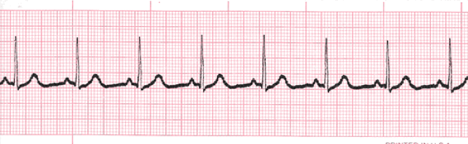 Heart arrhythmia rhythm strip readings