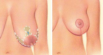 Areola boob implants