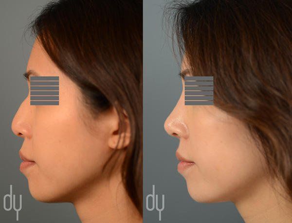 best of Nose augmentation Asian