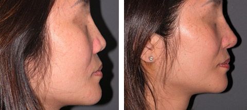 Green T. reccomend Asian nose augmentation