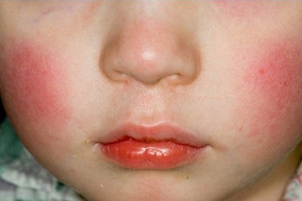 Sierra reccomend Asthma symptoms facial blotching or flushing