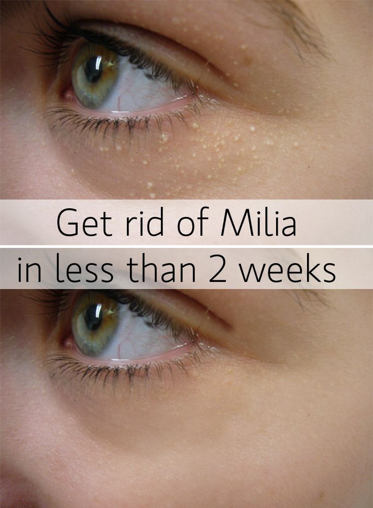 Milia and self treatment and facial