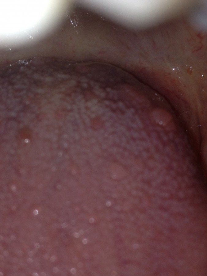 Sores in throat after giving blowjob