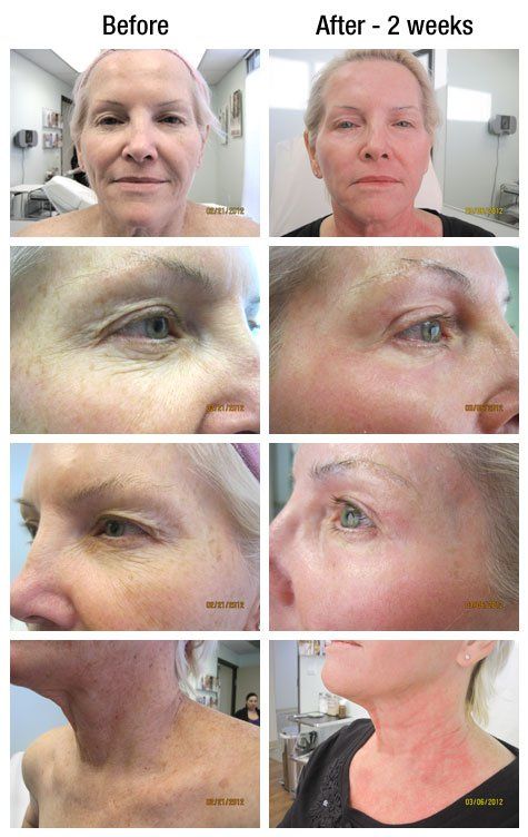 Severely dry facial skin and laser