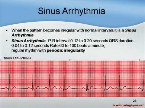 best of Readings rhythm strip Heart arrhythmia